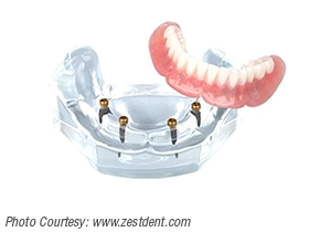 4-implants-overdenture