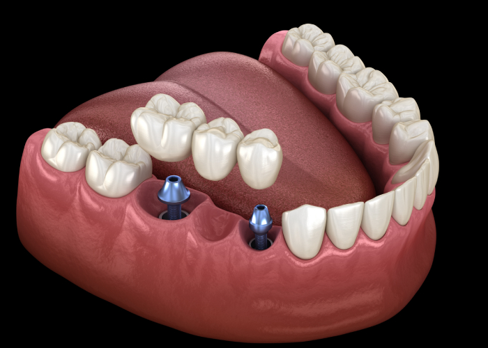 multi-toothb-bridge