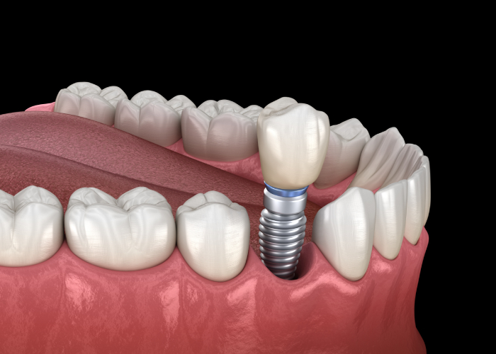 single-implants