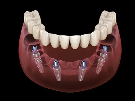All-On-4® Dental Implants