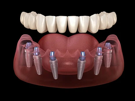 All-On-X Dental Implants