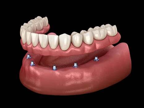 Full Mouth Dental Implants