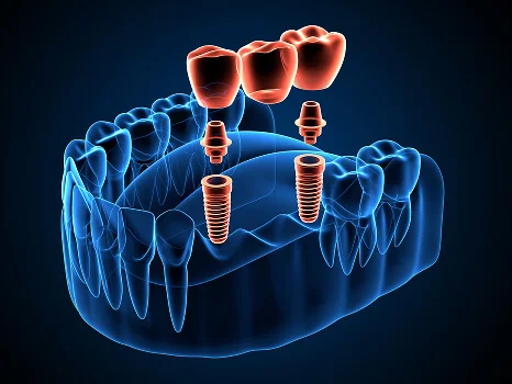 Implant Bridges