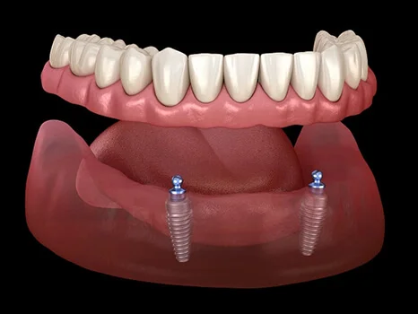 Implant-Supported Dentures