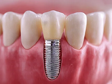 Single Tooth Implants