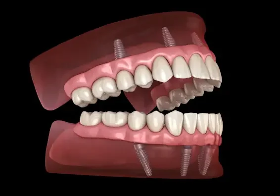 All-on-4® Implants