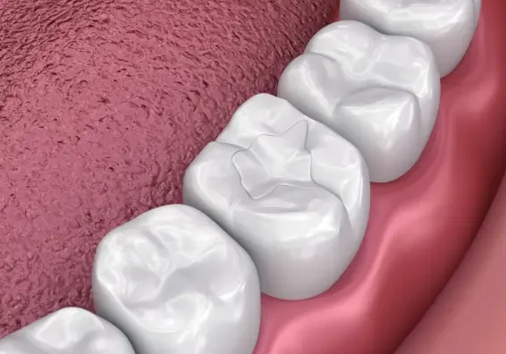 Dental Fillings