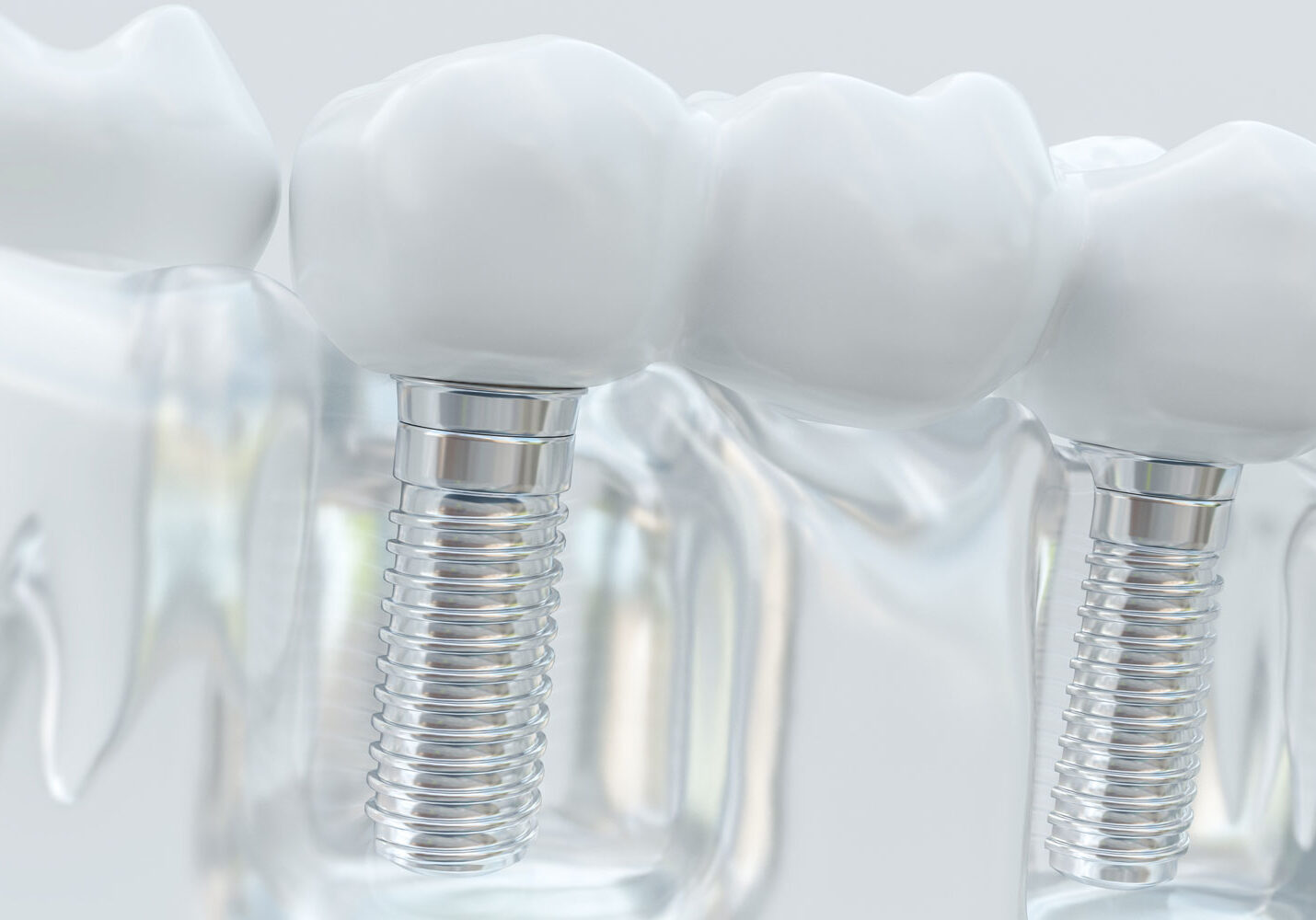 dental-implants