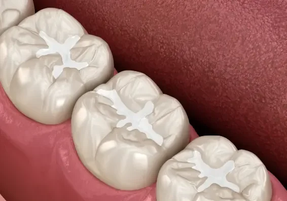 Dental Sealants