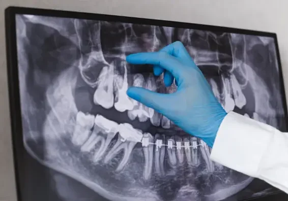 Digital Dental X-Rays