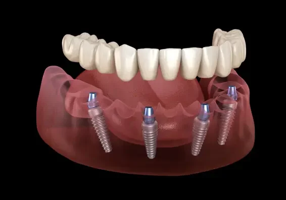 Implant-Supported Dentures