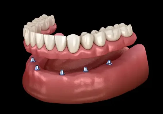 Mini Dental Implants