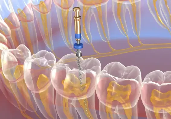 Root Canal Therapy