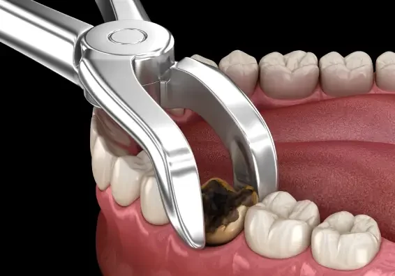 Tooth Extractions